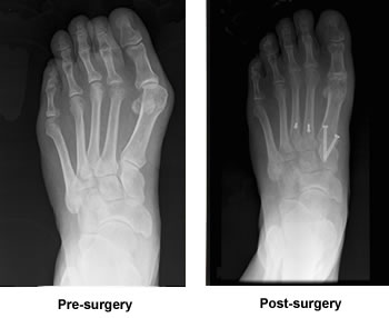 dislocated second toe surgery