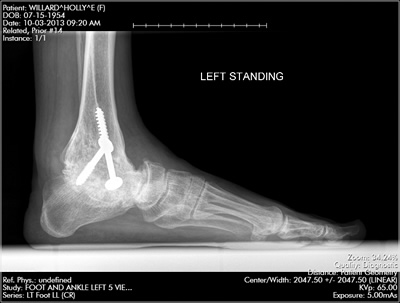 Ankle Fracture  Boston Medical Center